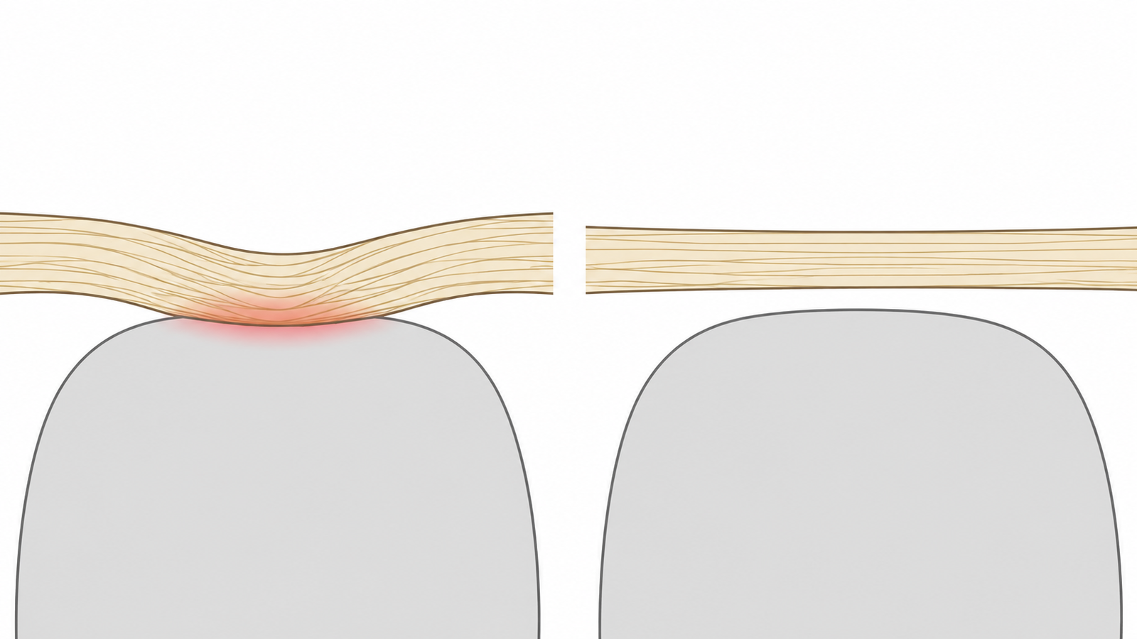 Same tendon, same hip. One of these irritates it and one of these rebuilds it.